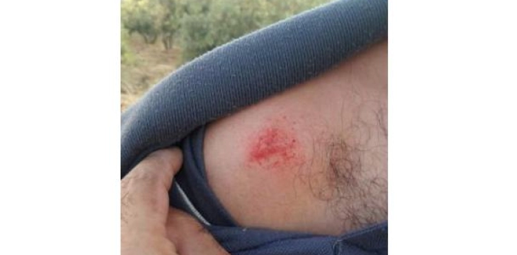 &quot;Biting&quot; one of the weapons of the occupation soldiers during the incursions