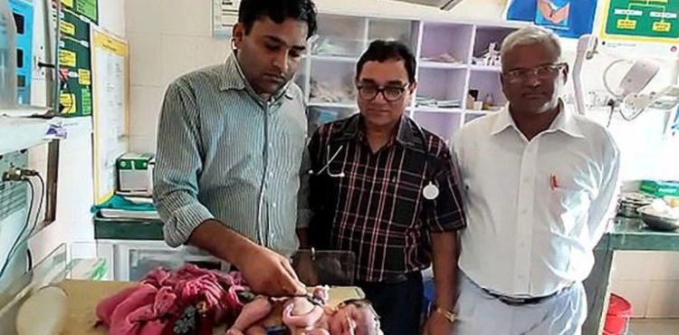 An Indian gives birth to a baby girl with four legs and three arms.