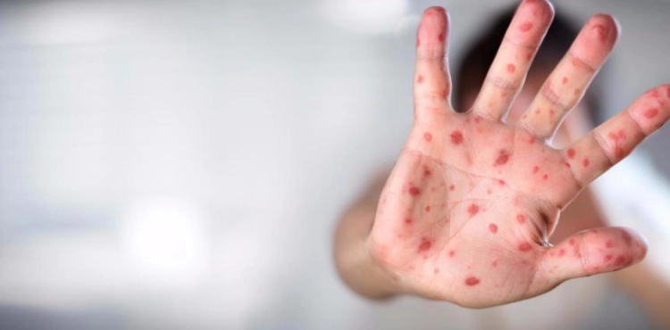 160 cases of measles in Gaza